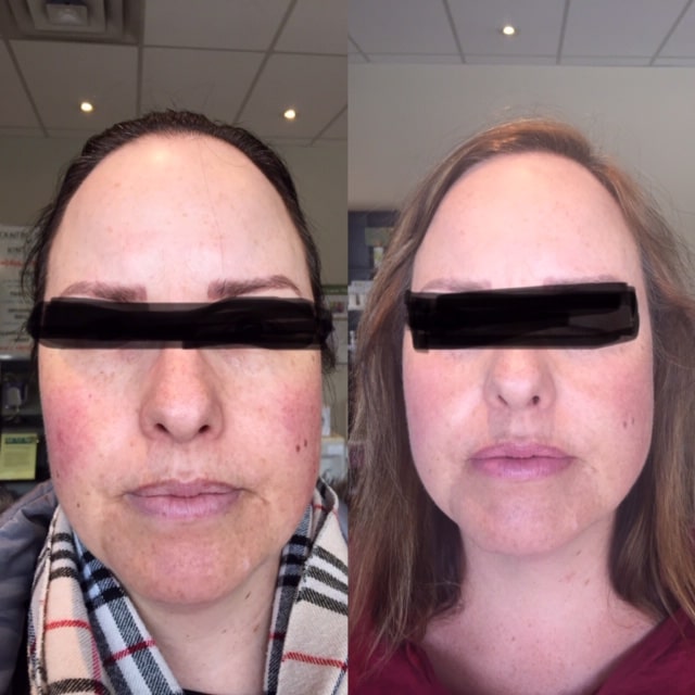 skin care before and after