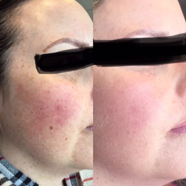 skin care before and after